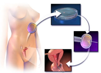 IVF - Assisted Reproductive Technology